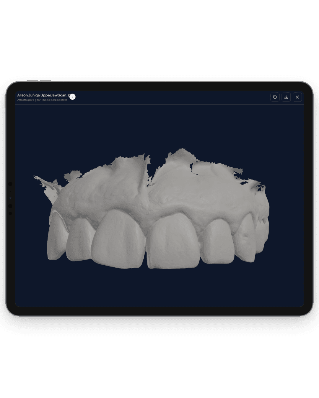 Escaneo intraoral de una arcada superior visto en 3D dentro de DentalBox, en una tablet